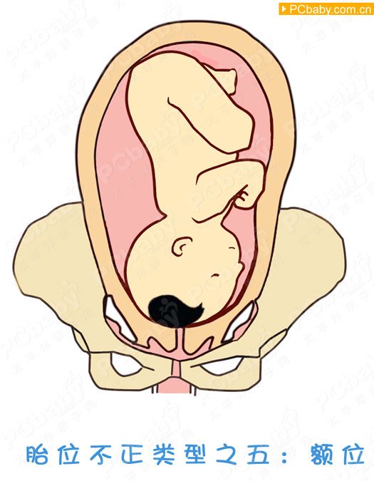 胎位loa示意图图片